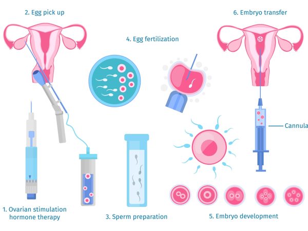  IVF vs IUI- which is better?